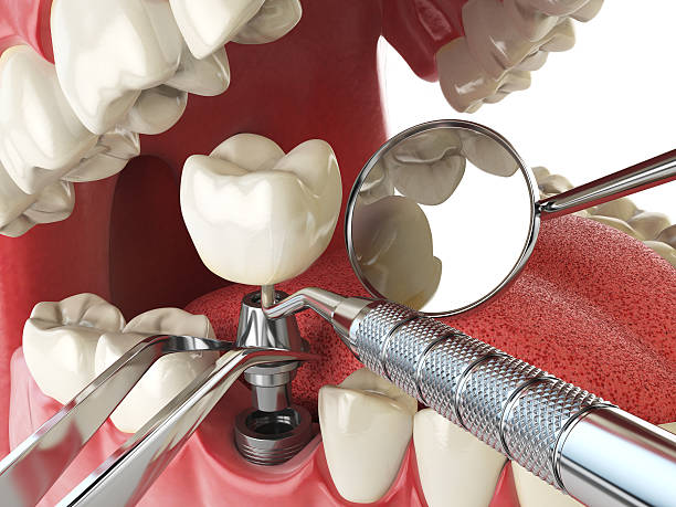 Best Emergency Root Canal Therapy in Crothersville, IN